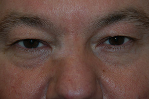 Blepharoplasty 6a
